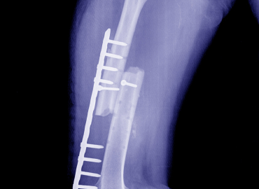  Ayak Bileği Protezi