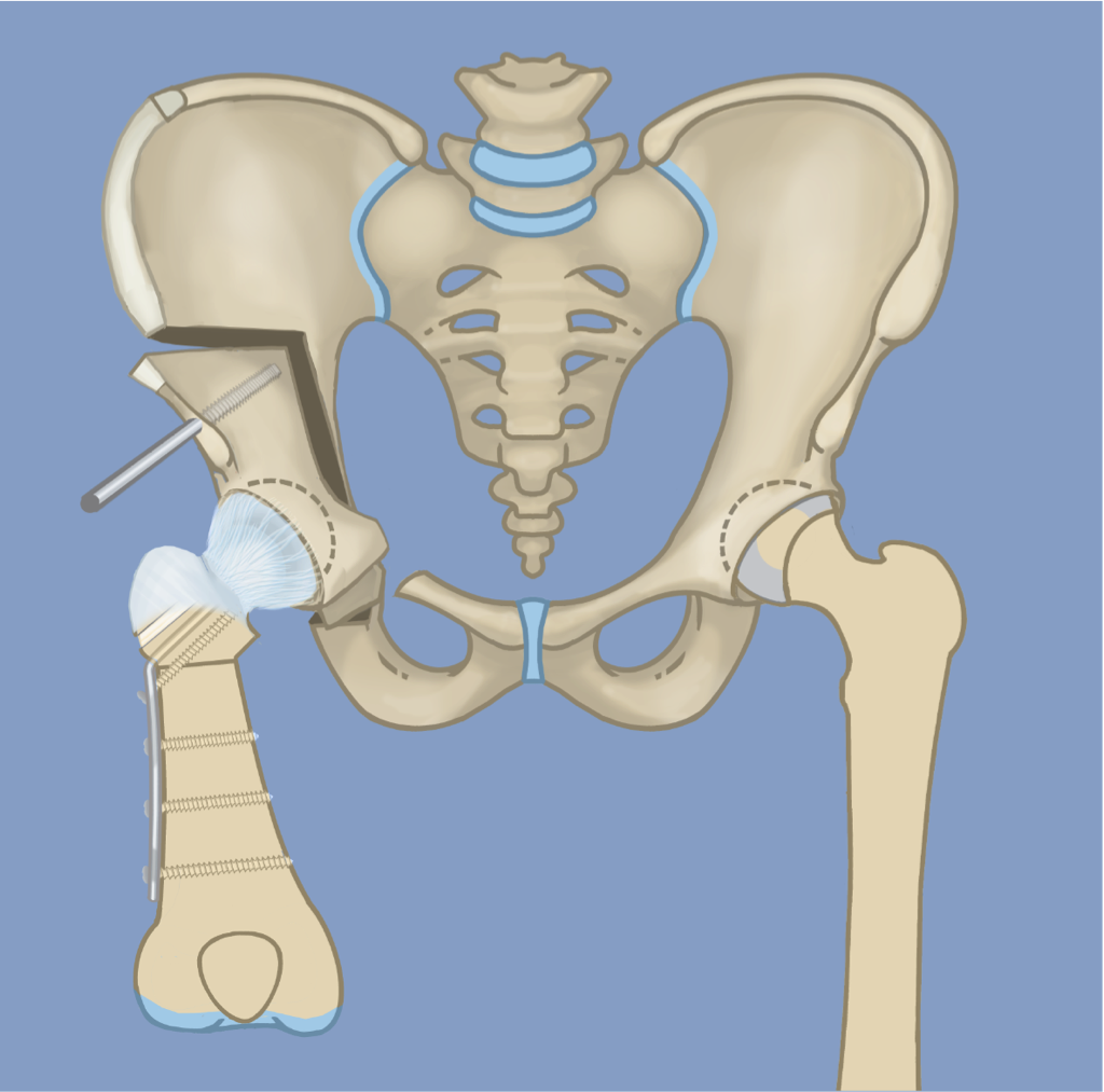  Kalça Osteotomisi
